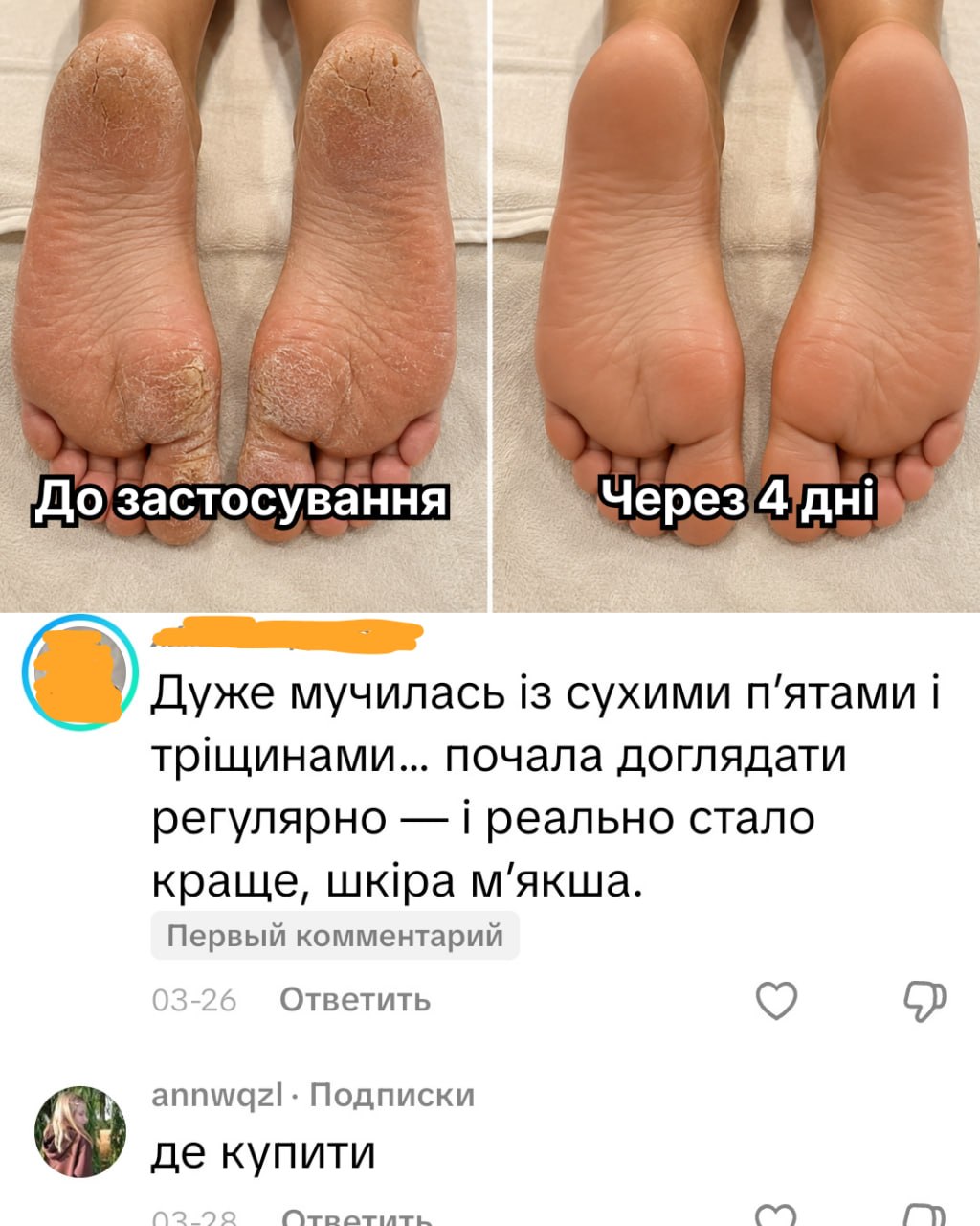 Відгук покупця ALVEA — п'яти до/після